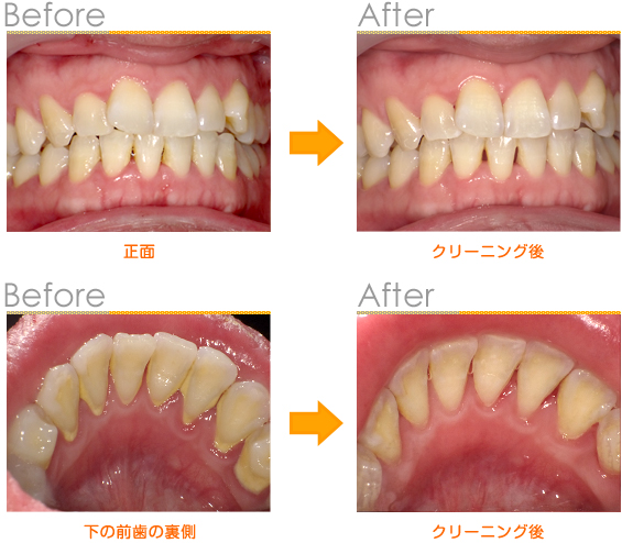 2015年4月の症例_とりやすい歯石