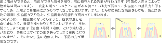 虫歯の治療以上に予防は大切です