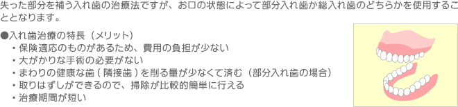 入れ歯治療のメリット