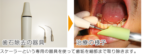 スケーラーという専用の器具を使って歯垢を細部まで取り除きます。
