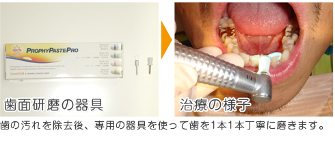 歯の汚れを除去後、専用の器具を使って歯を1本1本丁寧に磨きます。