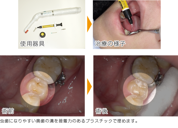 虫歯になりやすい奥歯の溝を接着力のあるプラスチックで埋めます。