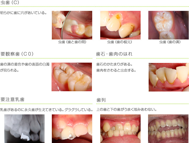 学校歯科健診の判定基準