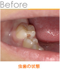 吉川市の歯科医院 ニーズ歯科の症例のご紹介です 16年6月の症例です