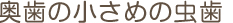 奥歯の小さめの虫歯