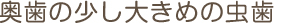 奥歯の少し大きめの虫歯