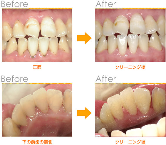 2015年4月の症例_硬い歯石