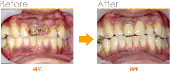 2015年5月の症例_保険の差し歯