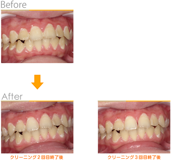 2015年11月の症例_術前と術後