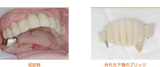 2015年4月の症例_ブリッジが外れた