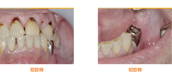 2015年4月の症例_硬い歯石