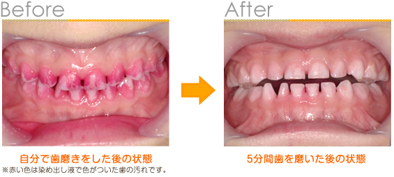 2016年5月の症例_歯磨き前と後