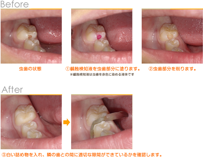 2016年6月の症例_虫歯治療（CR）