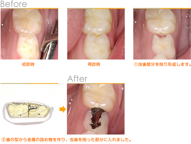 2016年6月の症例_虫歯治療（インレー）