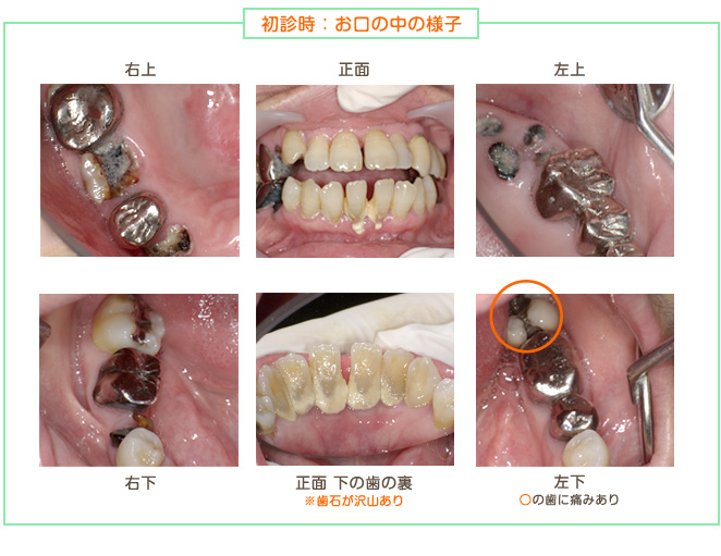 2016年7月の症例_初診時のお口の中の様子