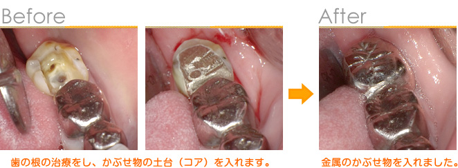 2016年7月の症例_金属の詰め物を入れました