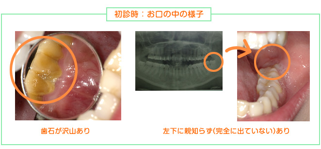 2016年7月の症例_開口障害_初診時のお口の中の様子