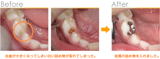 2016年8月の症例_歯の間の虫歯