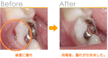 2016年8月の症例_歯茎の腫れ