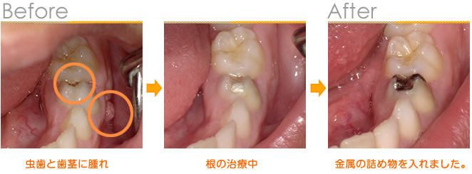 2016年8月の症例_虫歯と歯茎の腫れ
