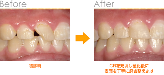 2016年9月の症例_前歯のむし歯（再充填）