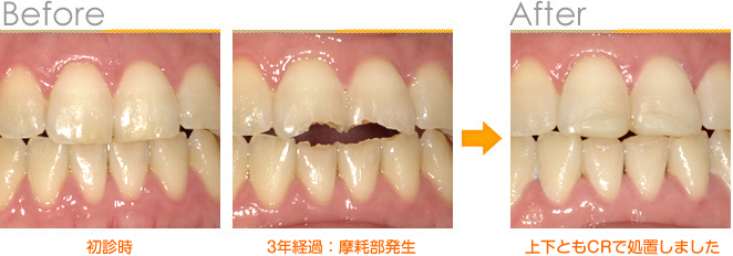 2016年9月の症例_前歯の摩耗