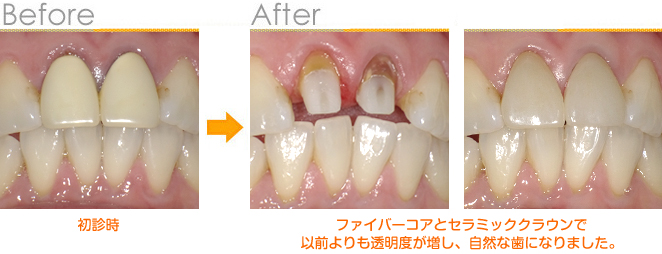 2016年10月の症例_ファイバーコアとセラミッククラウン