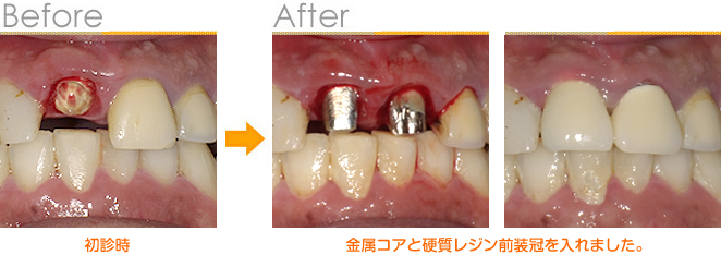 2016年10月の症例_金属コアと硬質レジン前装冠