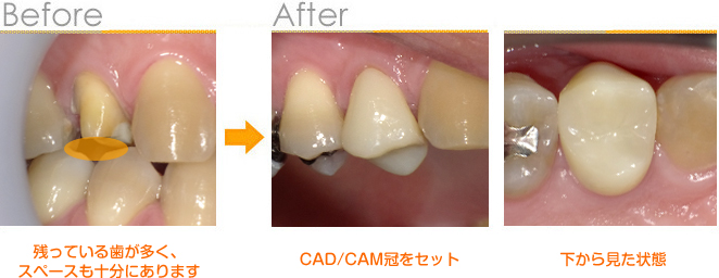 2016年11月の症例_CAD/CAM冠に出来た症例