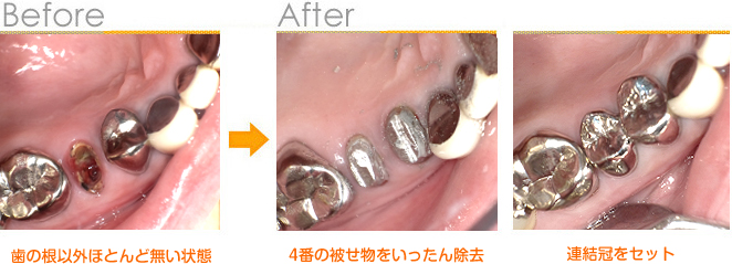 2016年11月の症例_CAD/CAM冠に出来なかった症例_Case1