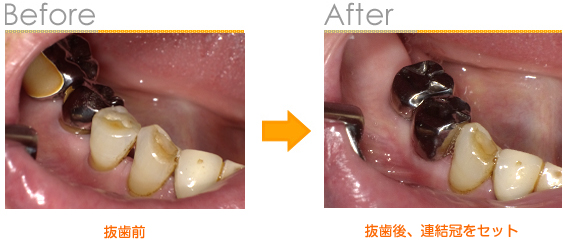 2016年11月の症例_CAD/CAM冠に出来なかった症例_Case3