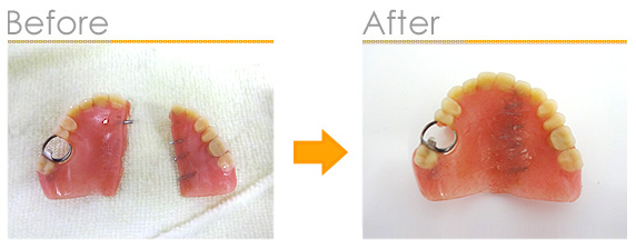 2016年12月の症例_保険と自費の入れ歯の比較1