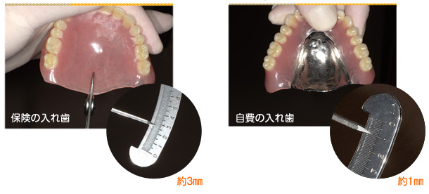 2016年12月の症例_保険と自費の入れ歯の比較2