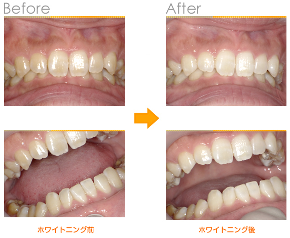 2017年2月の症例_ホワイトング_漂白前と後