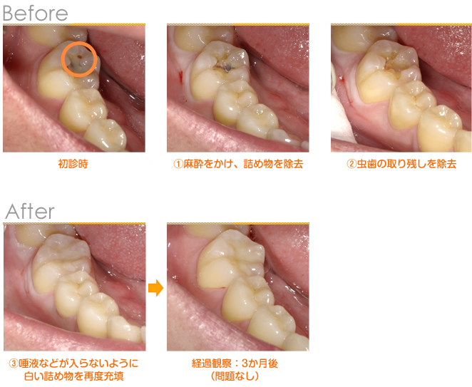 2018年2月の症例_奥歯に穴があいた
