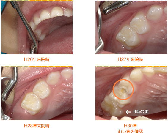 2018年6月の症例_健診でむし歯