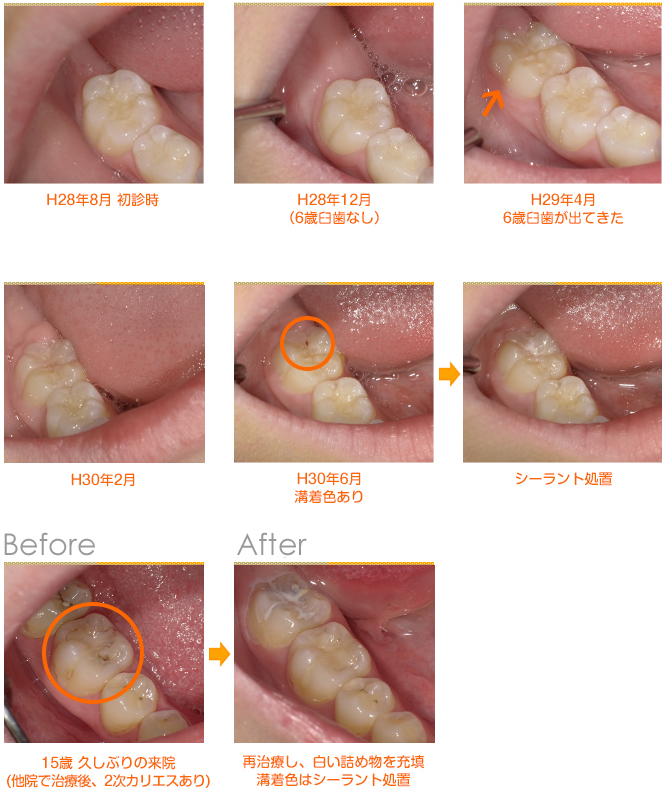 2018年7月の症例_虫歯を繰り返す