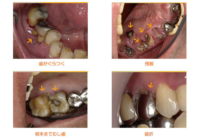 2018年8月の症例_抜歯の原因