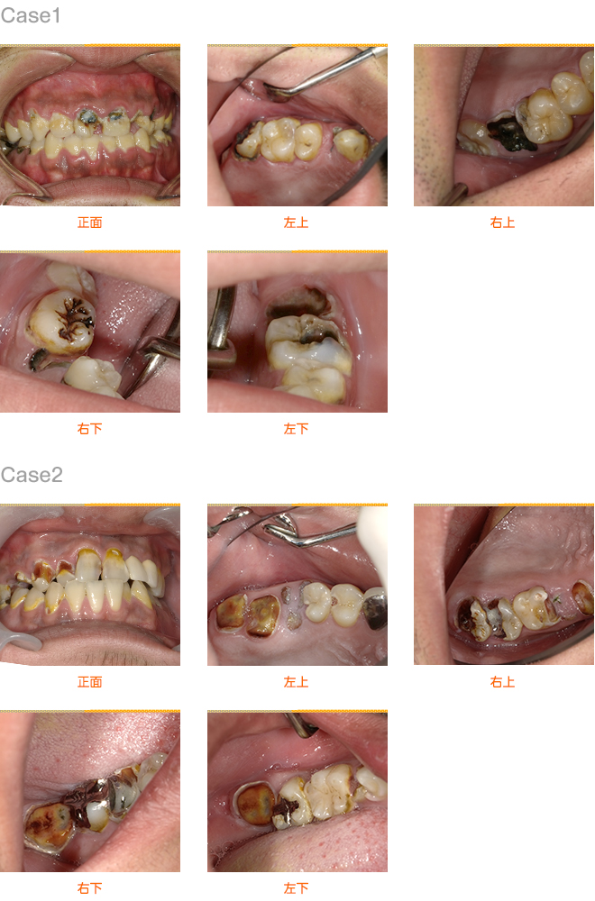 2018年9月の症例_虫歯を繰り返す