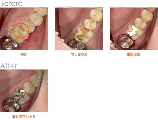2018年10月の症例_むし歯の再治療