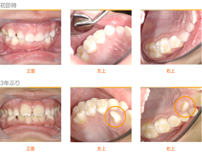 2018年11月の症例_歯並びへの悪影響