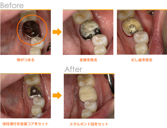 2018年12月の症例_自費のメタルボンド冠