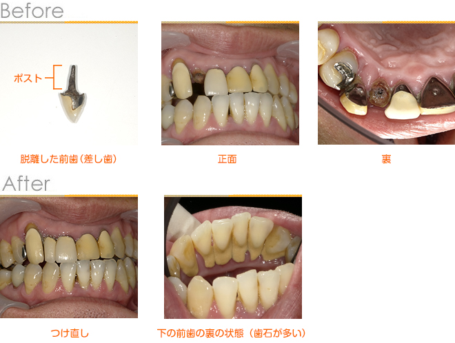 2019年1月の症例_前歯の脱離つけ直し